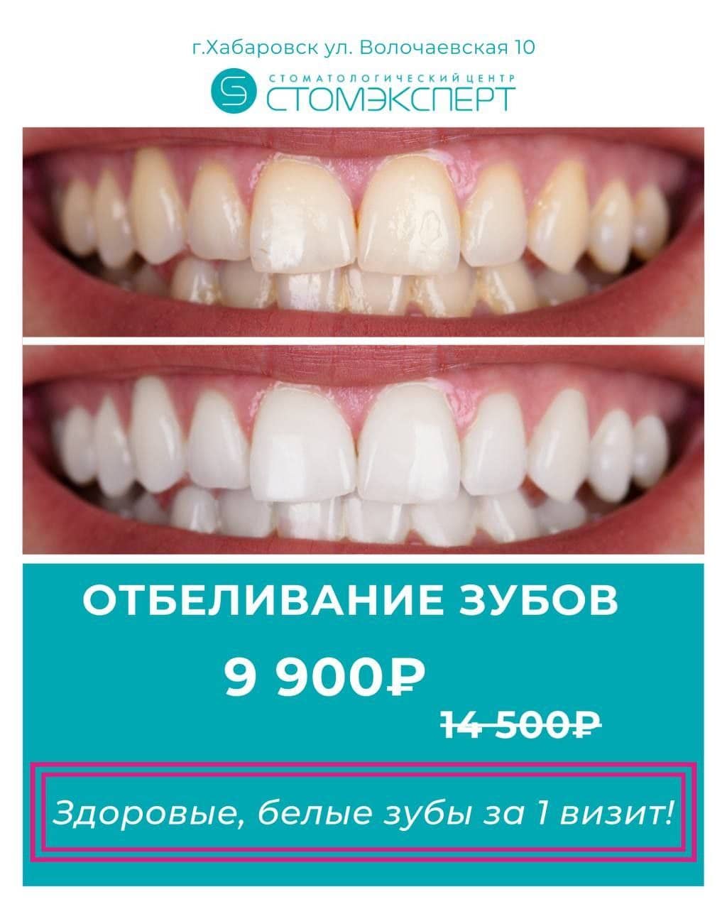 Отбеливание зубов